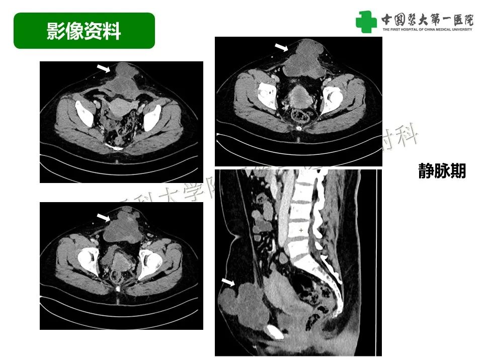 影像PPT - 【病例】腹壁子宫内膜异位症恶变-透明细胞癌-6