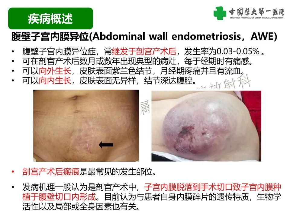 影像PPT - 【病例】腹壁子宫内膜异位症恶变-透明细胞癌-11