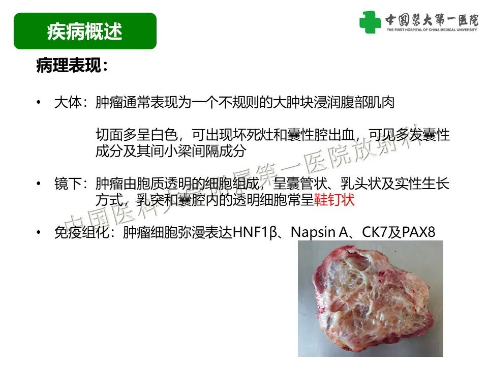 影像PPT - 【病例】腹壁子宫内膜异位症恶变-透明细胞癌-14