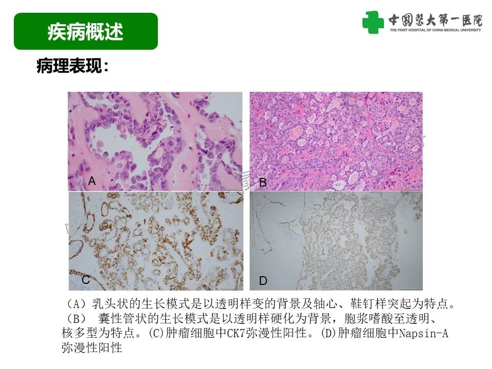 影像PPT - 【病例】腹壁子宫内膜异位症恶变-透明细胞癌-15