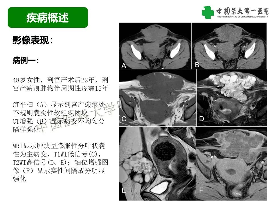 影像PPT - 【病例】腹壁子宫内膜异位症恶变-透明细胞癌-16