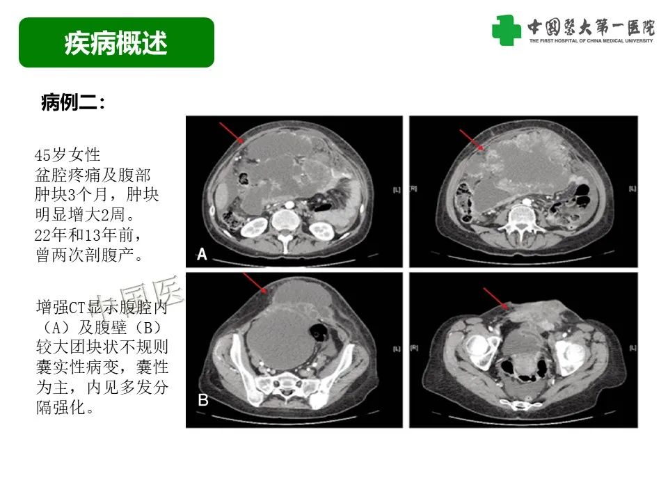 影像PPT - 【病例】腹壁子宫内膜异位症恶变-透明细胞癌-17
