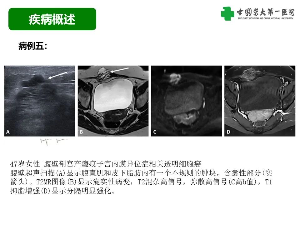 影像PPT - 【病例】腹壁子宫内膜异位症恶变-透明细胞癌-20