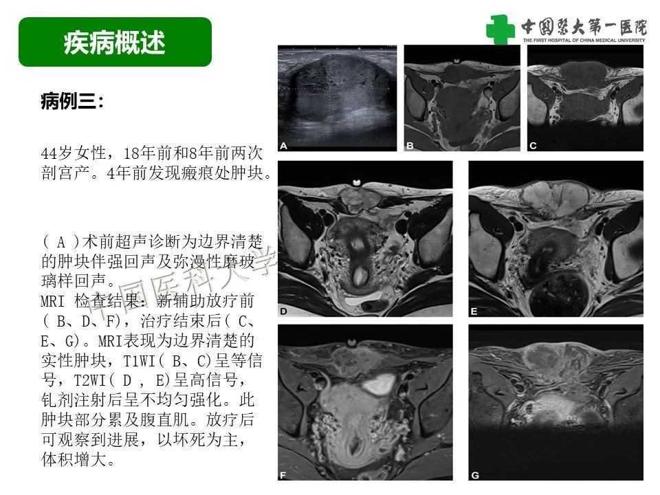 影像PPT - 【病例】腹壁子宫内膜异位症恶变-透明细胞癌-18