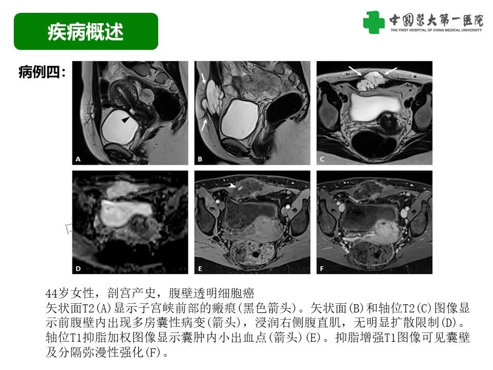 影像PPT - 【病例】腹壁子宫内膜异位症恶变-透明细胞癌-19