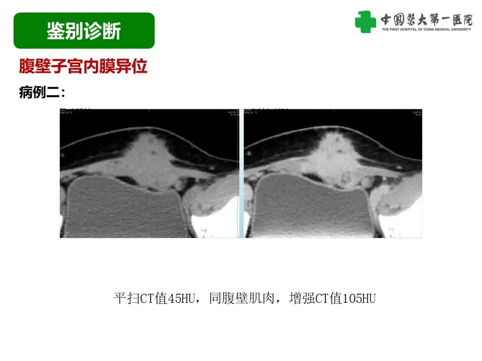 影像PPT - 【病例】腹壁子宫内膜异位症恶变-透明细胞癌-26