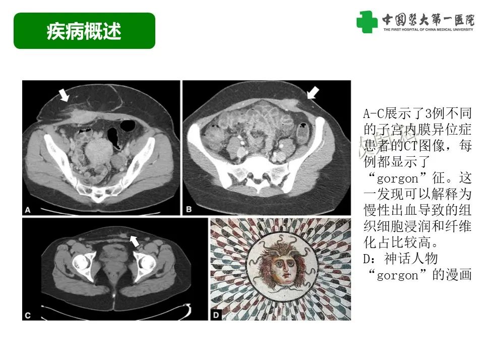 影像PPT - 【病例】腹壁子宫内膜异位症恶变-透明细胞癌-27