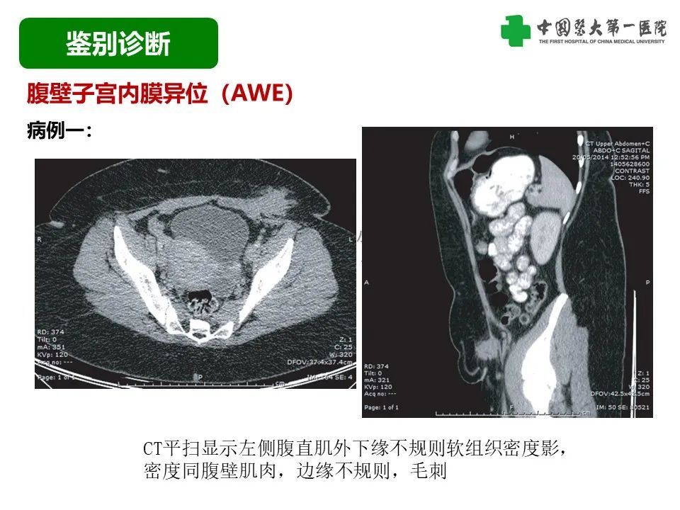 影像PPT - 【病例】腹壁子宫内膜异位症恶变-透明细胞癌-25