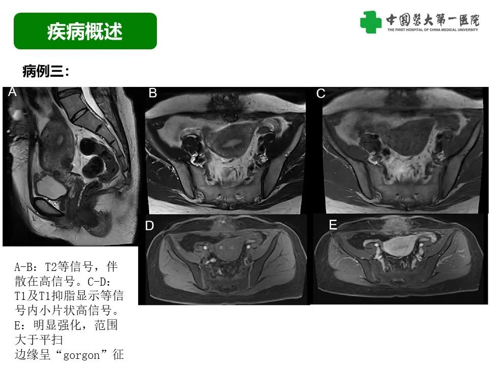 影像PPT - 【病例】腹壁子宫内膜异位症恶变-透明细胞癌-28
