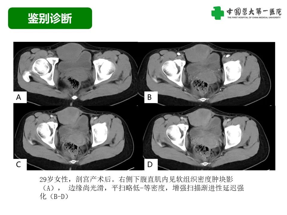 影像PPT - 【病例】腹壁子宫内膜异位症恶变-透明细胞癌-32