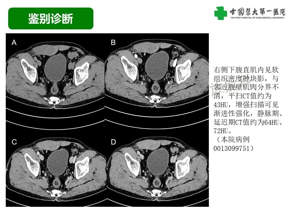 影像PPT - 【病例】腹壁子宫内膜异位症恶变-透明细胞癌-31