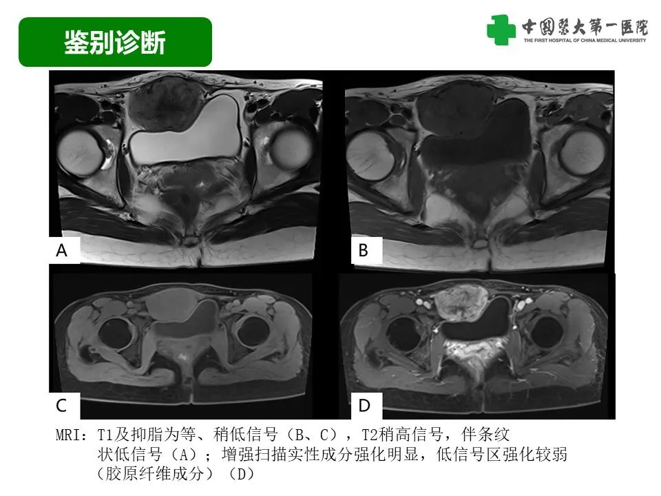 影像PPT - 【病例】腹壁子宫内膜异位症恶变-透明细胞癌-33