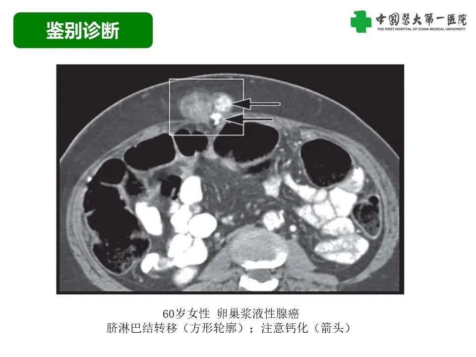影像PPT - 【病例】腹壁子宫内膜异位症恶变-透明细胞癌-35