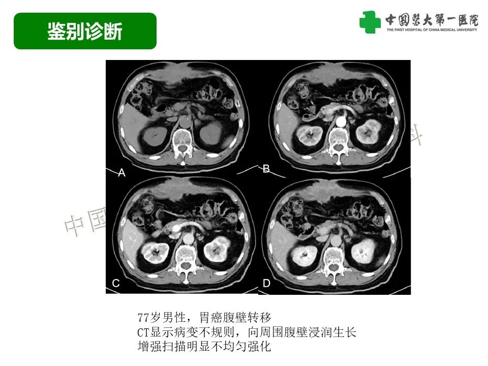 影像PPT - 【病例】腹壁子宫内膜异位症恶变-透明细胞癌-36