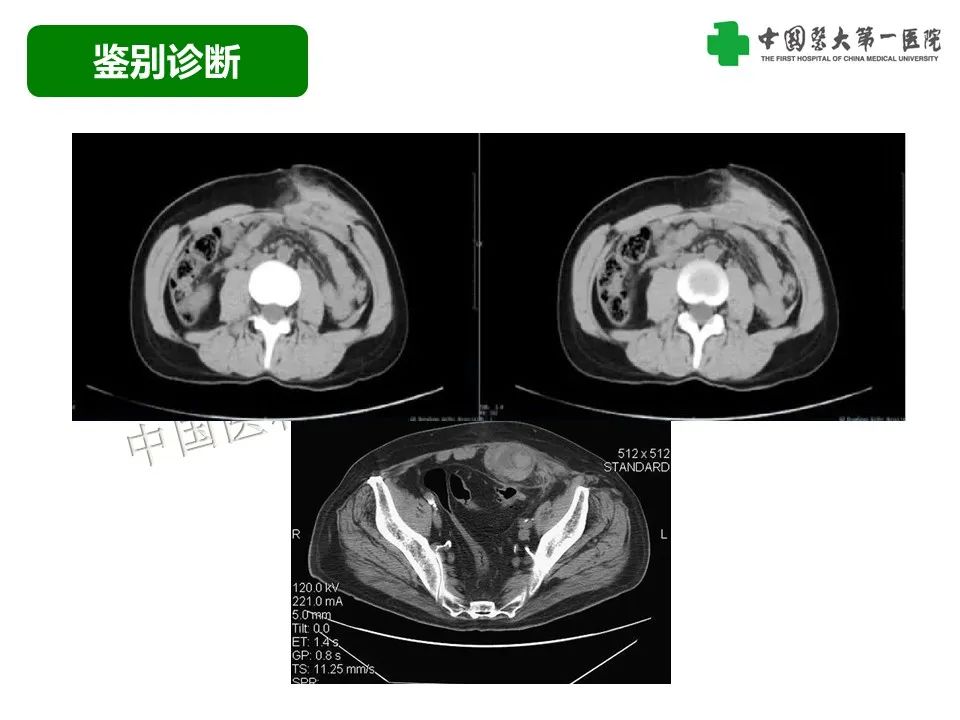 影像PPT - 【病例】腹壁子宫内膜异位症恶变-透明细胞癌-38