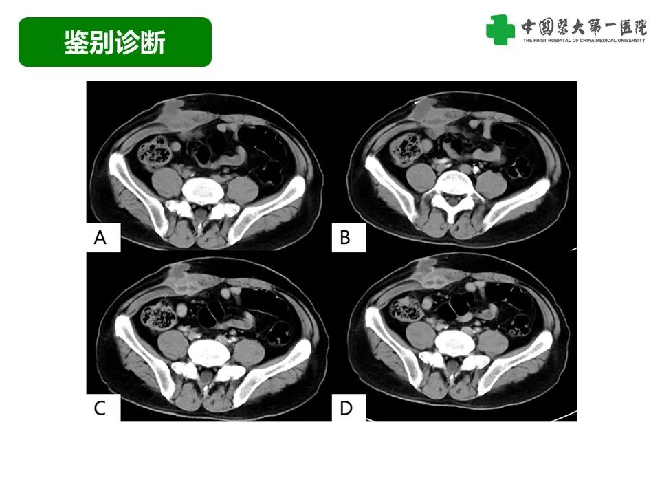 影像PPT - 【病例】腹壁子宫内膜异位症恶变-透明细胞癌-40