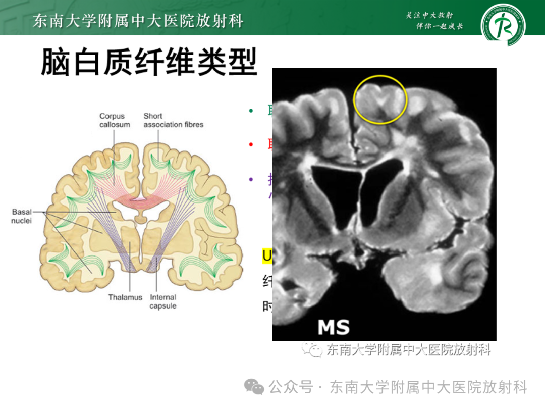 影像PPT - 【PPT】成人脑白质受累为主的弥漫/融合分布病变的诊断思路-3