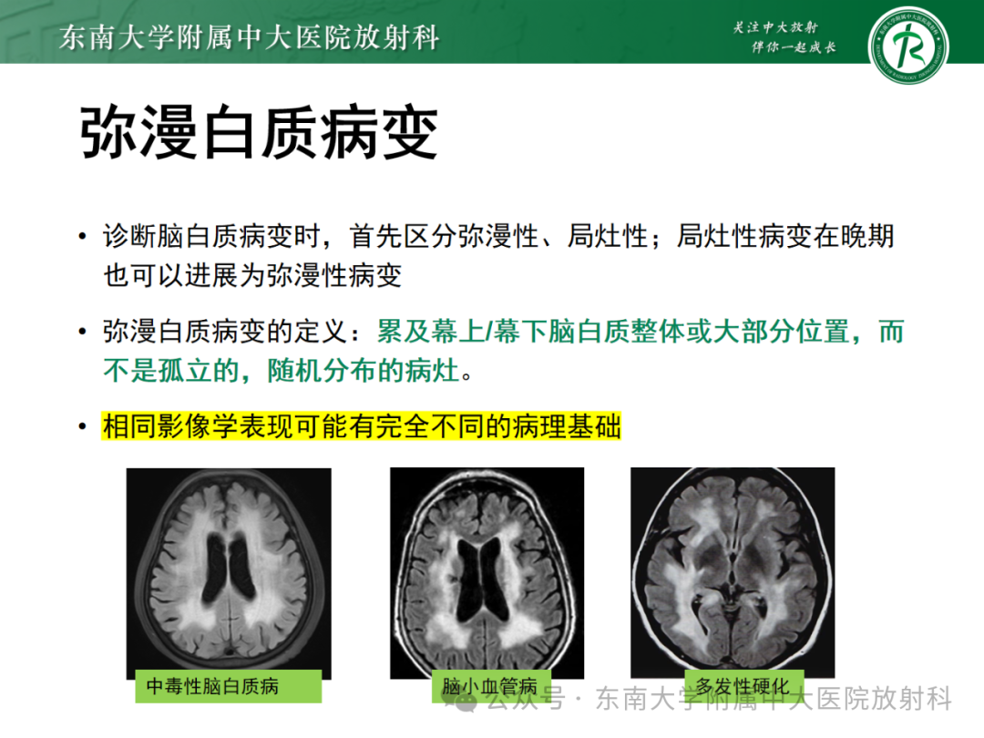 影像PPT - 【PPT】成人脑白质受累为主的弥漫/融合分布病变的诊断思路-7