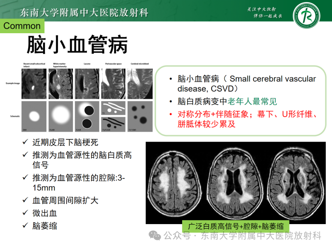 影像PPT - 【PPT】成人脑白质受累为主的弥漫/融合分布病变的诊断思路-10