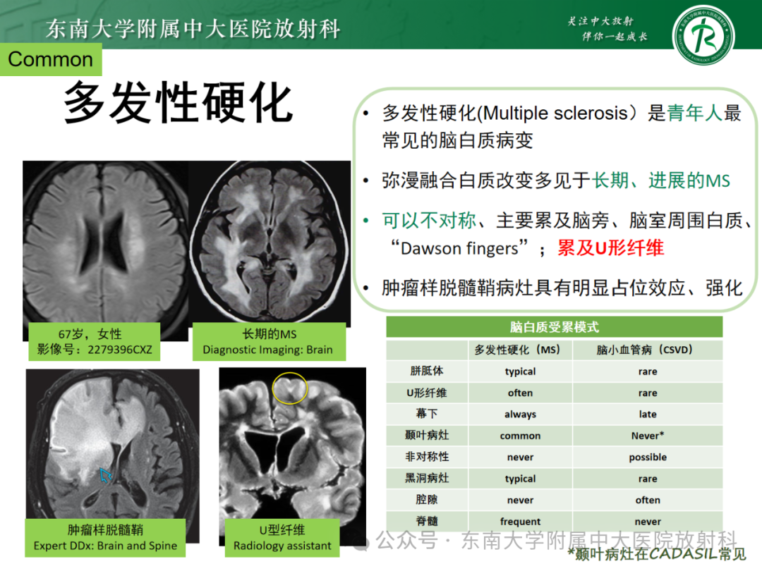 影像PPT - 【PPT】成人脑白质受累为主的弥漫/融合分布病变的诊断思路-11