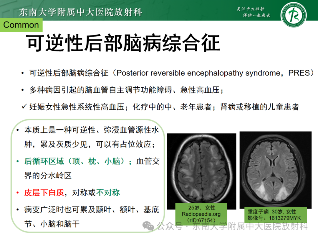 影像PPT - 【PPT】成人脑白质受累为主的弥漫/融合分布病变的诊断思路-12
