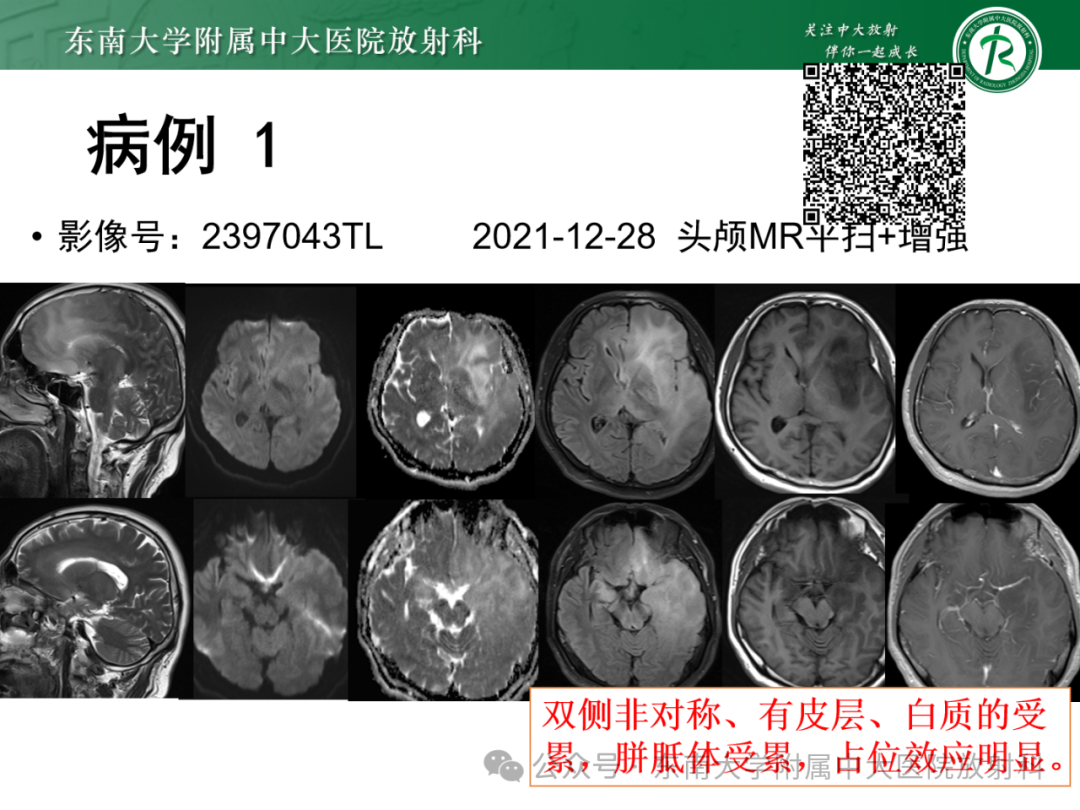 影像PPT - 【PPT】成人脑白质受累为主的弥漫/融合分布病变的诊断思路-14