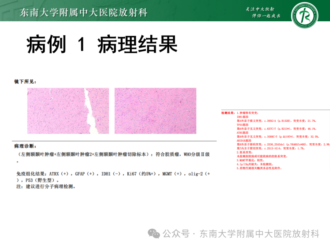 影像PPT - 【PPT】成人脑白质受累为主的弥漫/融合分布病变的诊断思路-16