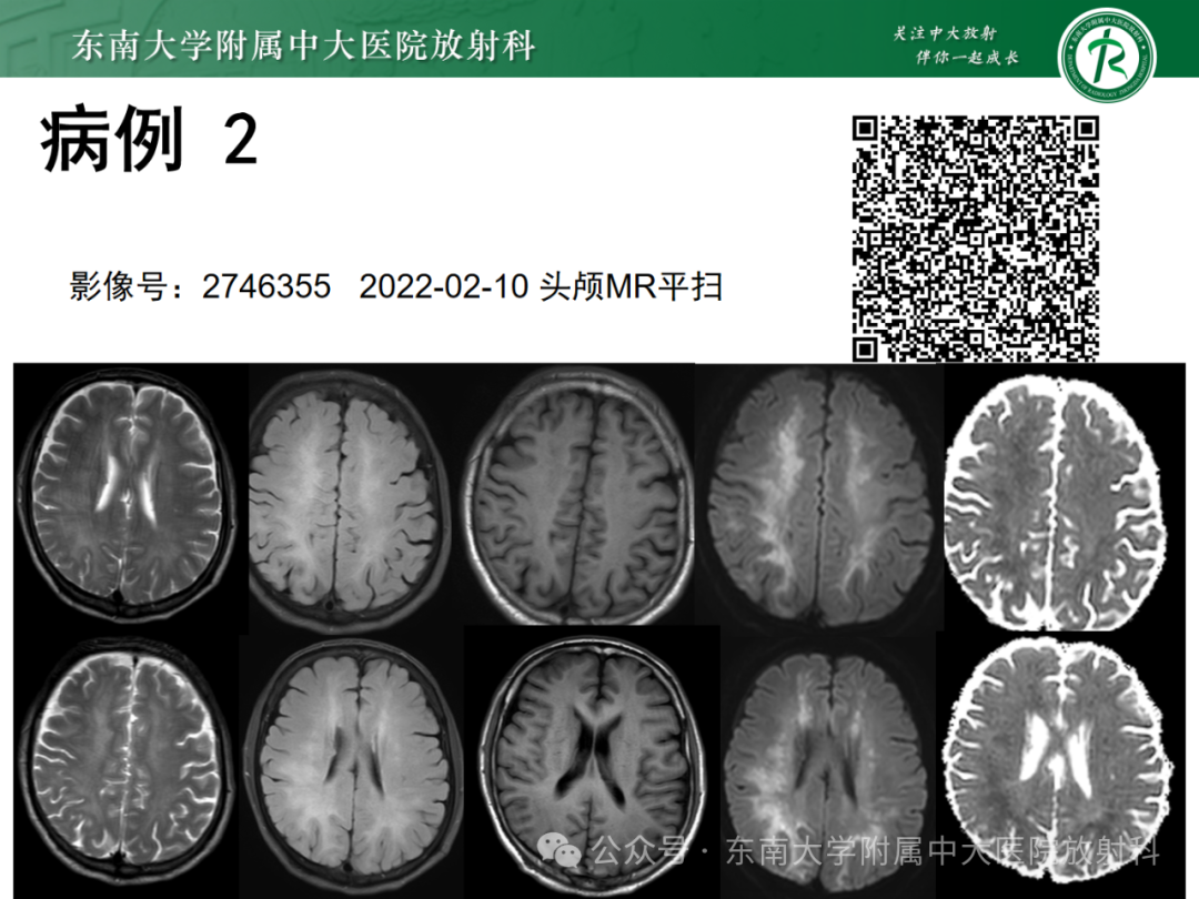 影像PPT - 【PPT】成人脑白质受累为主的弥漫/融合分布病变的诊断思路-18