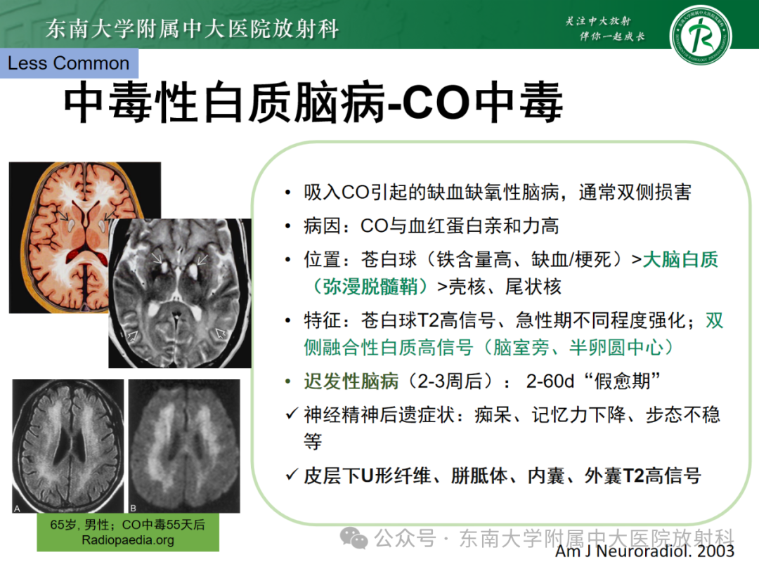 影像PPT - 【PPT】成人脑白质受累为主的弥漫/融合分布病变的诊断思路-20