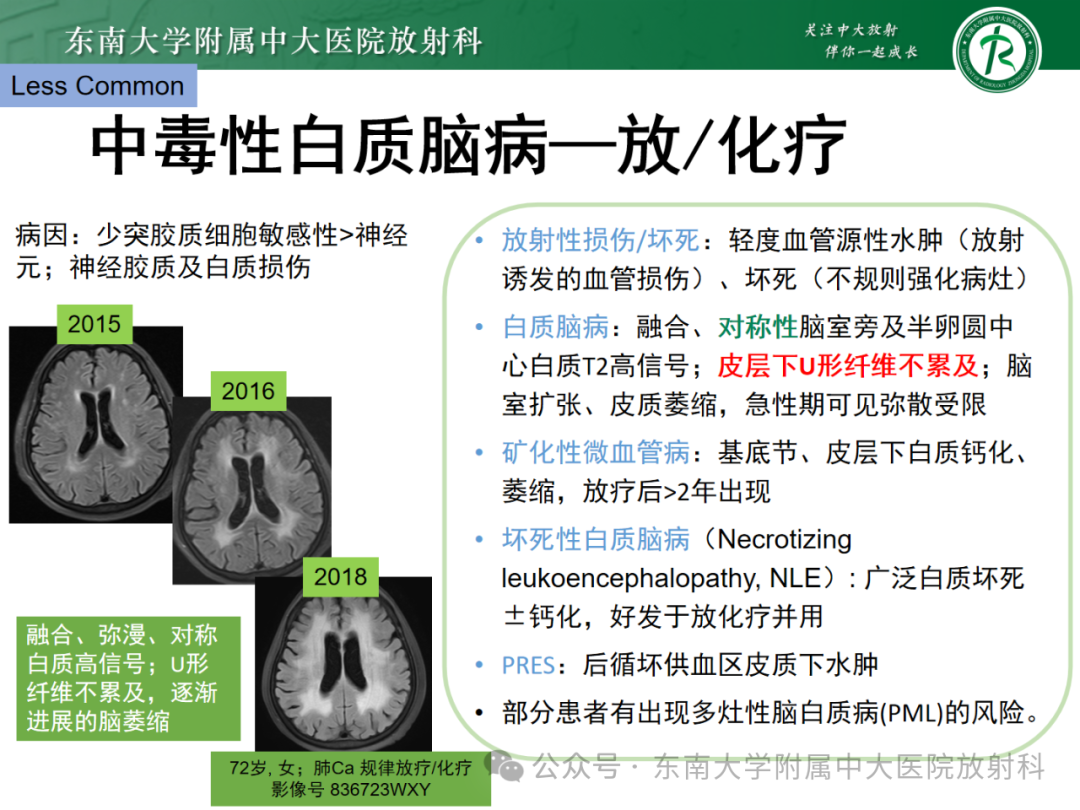影像PPT - 【PPT】成人脑白质受累为主的弥漫/融合分布病变的诊断思路-21