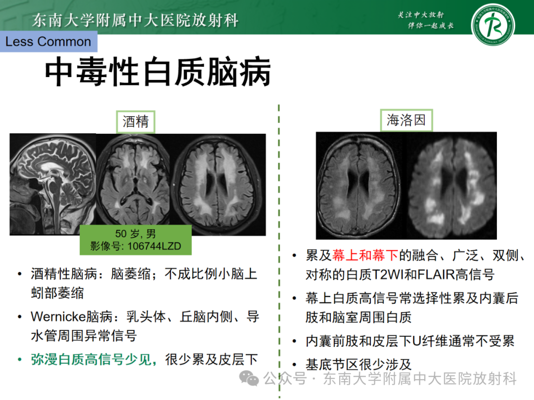 影像PPT - 【PPT】成人脑白质受累为主的弥漫/融合分布病变的诊断思路-29