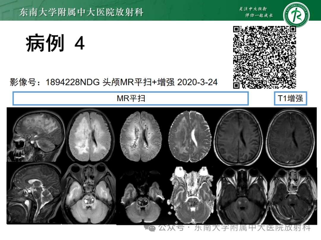 影像PPT - 【PPT】成人脑白质受累为主的弥漫/融合分布病变的诊断思路-33