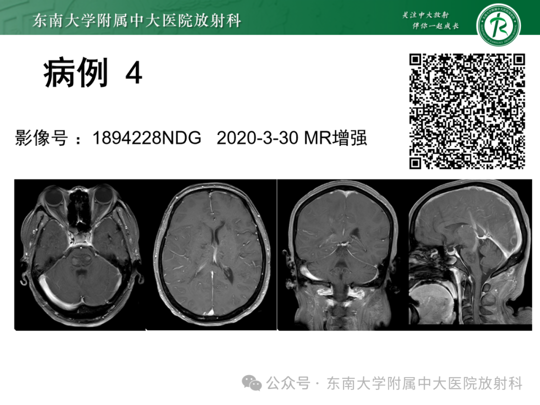 影像PPT - 【PPT】成人脑白质受累为主的弥漫/融合分布病变的诊断思路-34