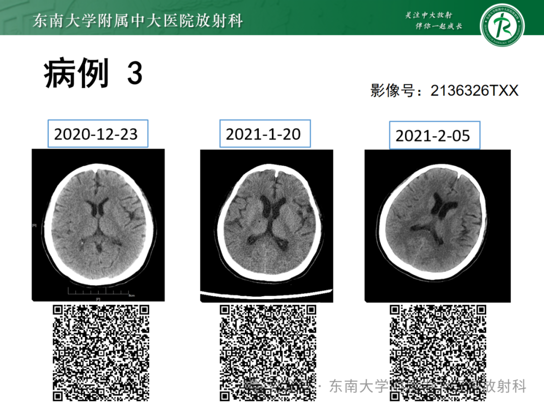 影像PPT - 【PPT】成人脑白质受累为主的弥漫/融合分布病变的诊断思路-26