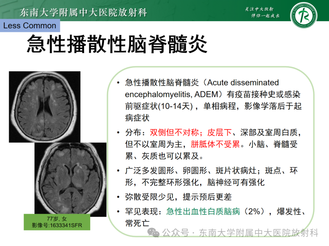 影像PPT - 【PPT】成人脑白质受累为主的弥漫/融合分布病变的诊断思路-36