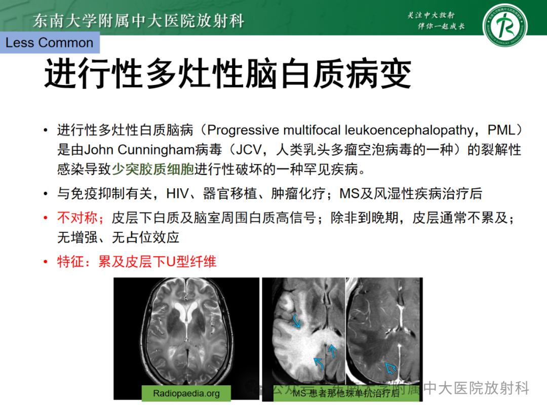 影像PPT - 【PPT】成人脑白质受累为主的弥漫/融合分布病变的诊断思路-38
