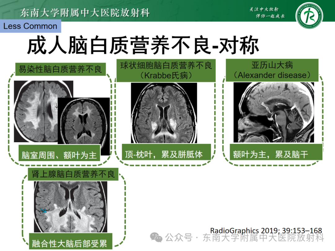 影像PPT - 【PPT】成人脑白质受累为主的弥漫/融合分布病变的诊断思路-39