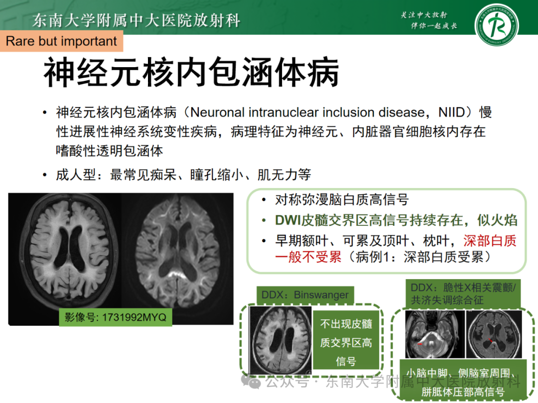 影像PPT - 【PPT】成人脑白质受累为主的弥漫/融合分布病变的诊断思路-41