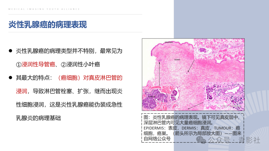影像PPT - 【PPT】炎性乳腺癌的诊断及鉴别诊断-6