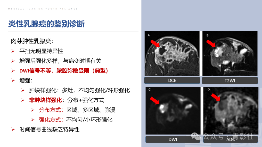 影像PPT - 【PPT】炎性乳腺癌的诊断及鉴别诊断-9