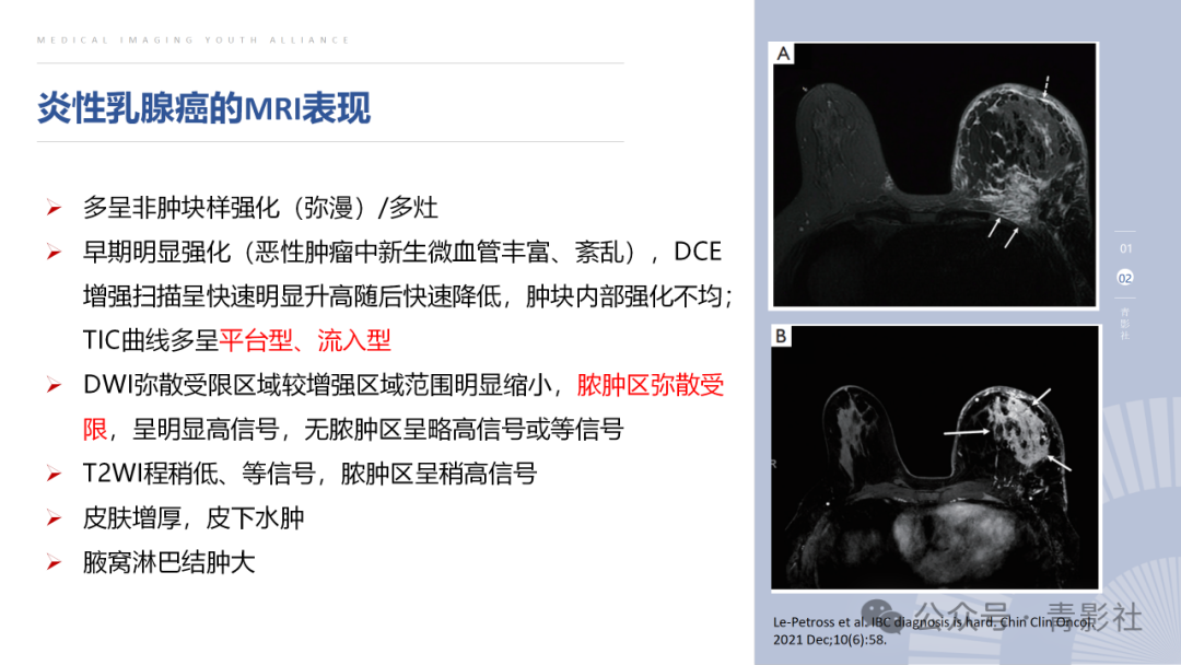 影像PPT - 【PPT】炎性乳腺癌的诊断及鉴别诊断-7