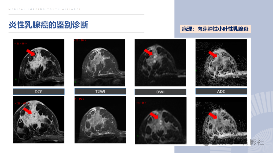 影像PPT - 【PPT】炎性乳腺癌的诊断及鉴别诊断-12