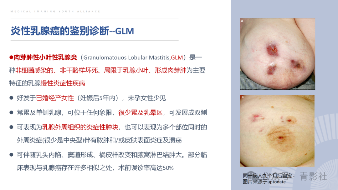影像PPT - 【PPT】炎性乳腺癌的诊断及鉴别诊断-8
