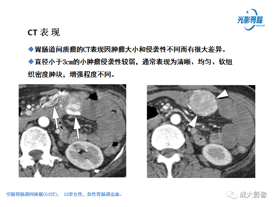 影像PPT - 【PPT】胃肠道上皮下富血供肿瘤及肿瘤样病变的CT表现-8