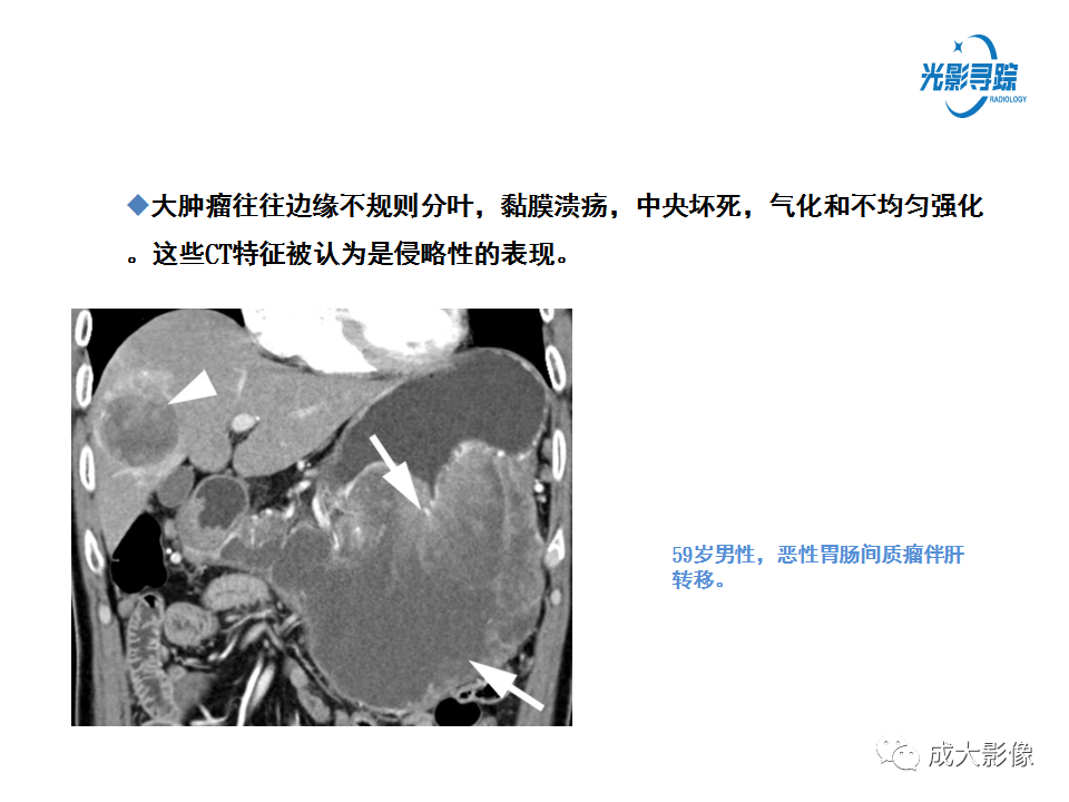 影像PPT - 【PPT】胃肠道上皮下富血供肿瘤及肿瘤样病变的CT表现-9