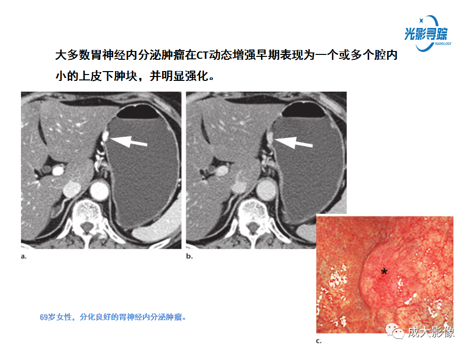 影像PPT - 【PPT】胃肠道上皮下富血供肿瘤及肿瘤样病变的CT表现-13