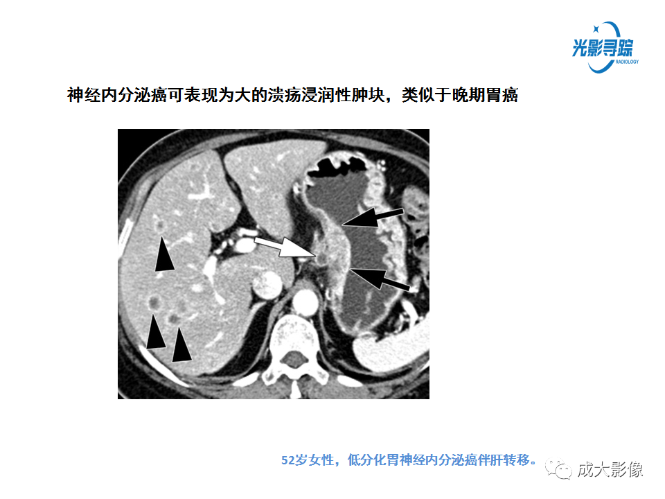 影像PPT - 【PPT】胃肠道上皮下富血供肿瘤及肿瘤样病变的CT表现-14