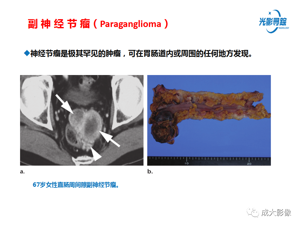影像PPT - 【PPT】胃肠道上皮下富血供肿瘤及肿瘤样病变的CT表现-31
