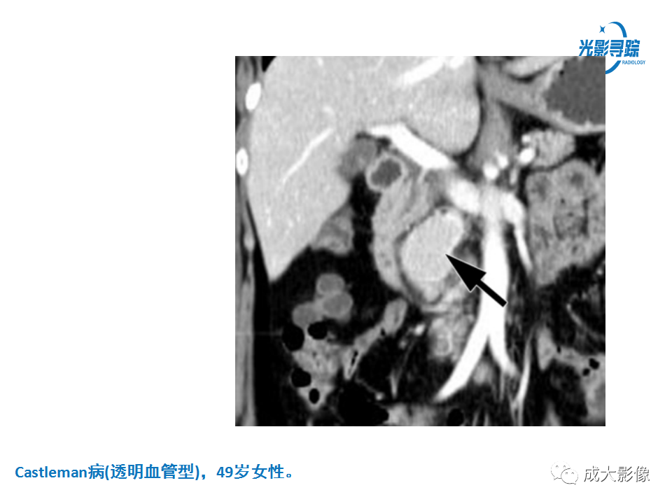 影像PPT - 【PPT】胃肠道上皮下富血供肿瘤及肿瘤样病变的CT表现-34