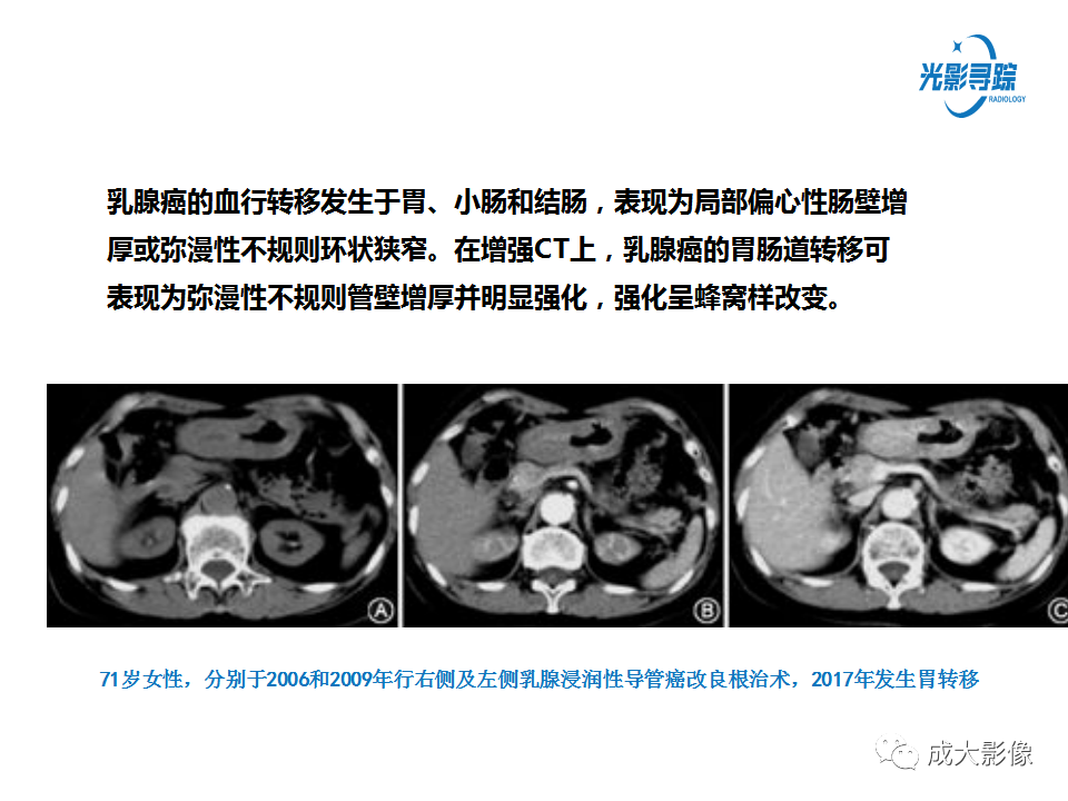 影像PPT - 【PPT】胃肠道上皮下富血供肿瘤及肿瘤样病变的CT表现-38